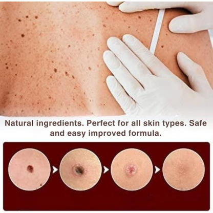 Skin Tag and Wart Remover Pen with Precision Brush Tip