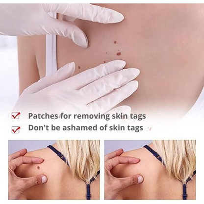 Skin Tag and Wart Remover Pen with Precision Brush Tip